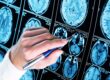 a medical professional points to multiple images of brain scans to explain the link between autism, seizures, and epilepsy