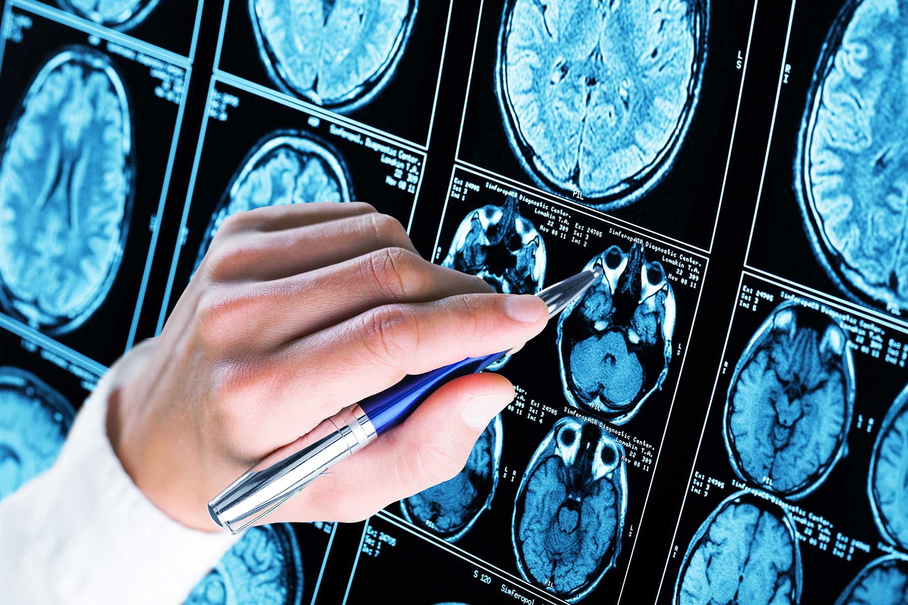 The Link Between Autism, Seizures, and Epilepsy a medical professional points to multiple images of brain scans to explain the link between autism, seizures, and epilepsy